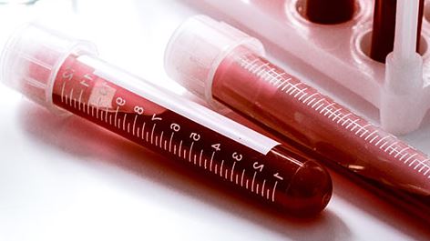 Eigenbluttherapie: Eigenblut tut gut!